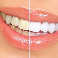 методы для отбеливания зубов